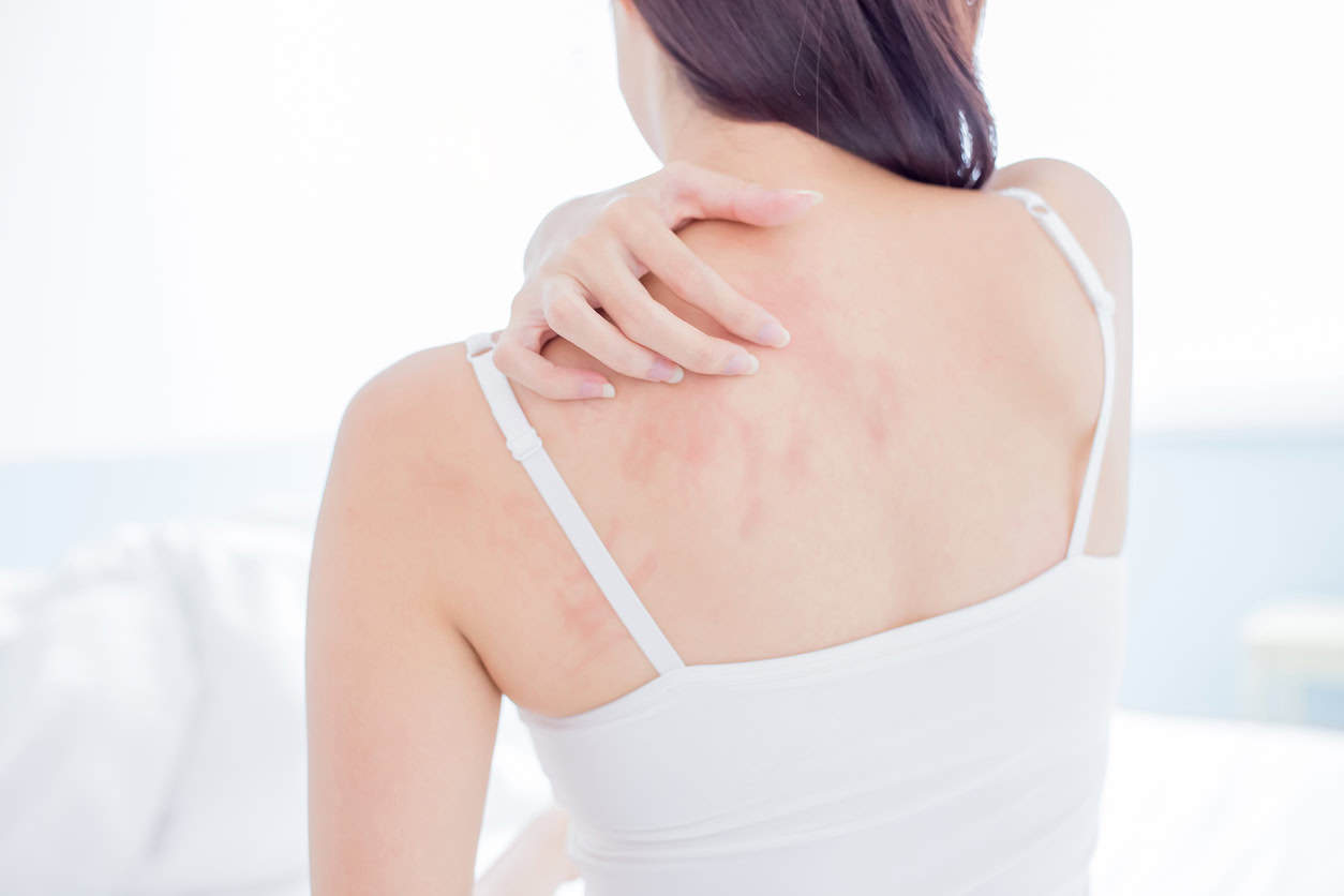 woman scratching her shoulder and neck where she has signs of eczema.