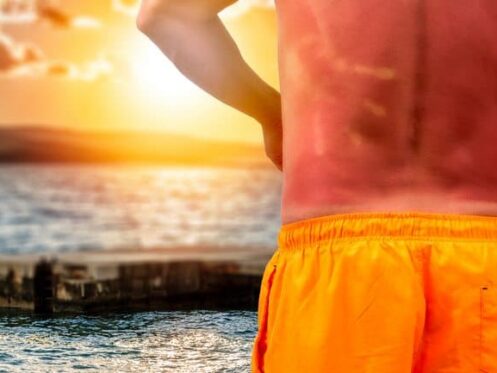 Man at the beach with a bad sunburn